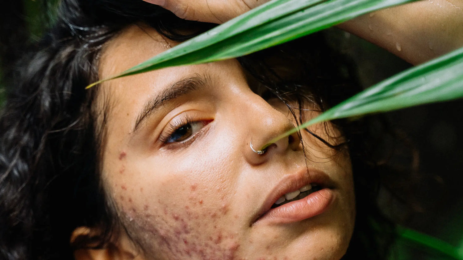 l'acné est naturel 